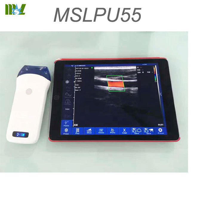 Iphone us venous color doppler scan MSLPU55
