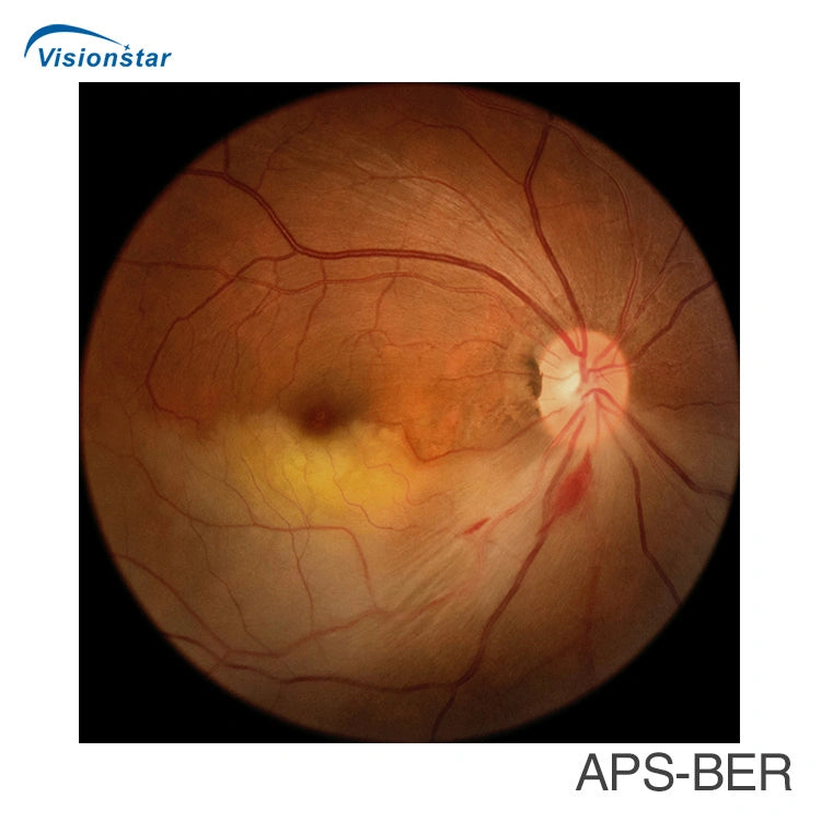 FDA Approved Aps-Ber Eye Digital Fundus Camera Price