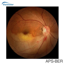 Load image into Gallery viewer, FDA Approved Aps-Ber Eye Digital Fundus Camera Price