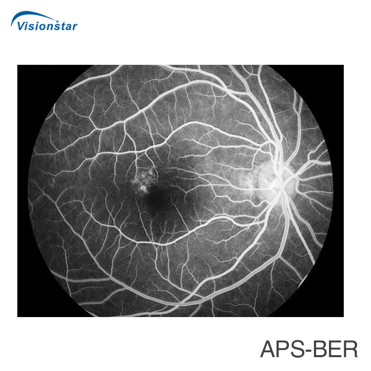 FDA Approved Aps-Ber Eye Digital Fundus Camera Price