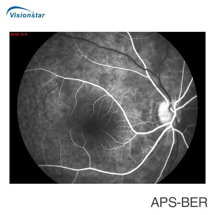 FDA Approved Aps-Ber Eye Digital Fundus Camera Price