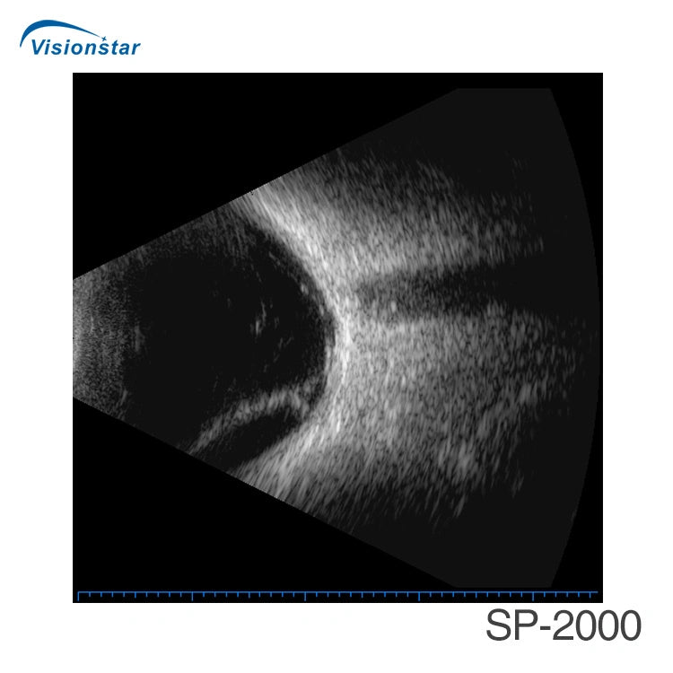 Sp-2000 China Eye Examination Portable Ultrasound Ab Scan Machine