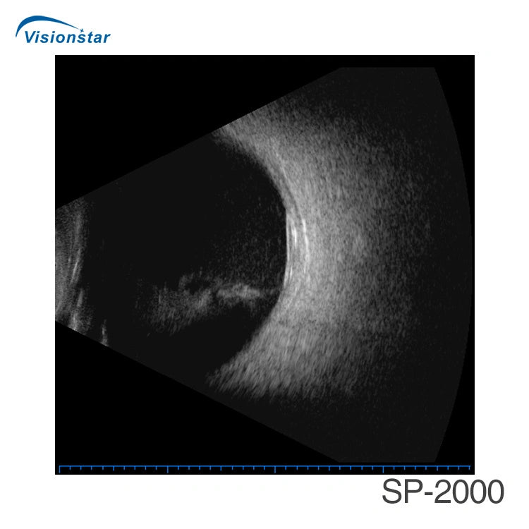 Sp-2000 China Eye Examination Portable Ultrasound Ab Scan Machine