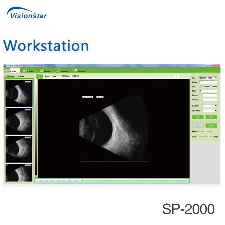 Sp-2000 China Eye Examination Portable Ultrasound Ab Scan Machine